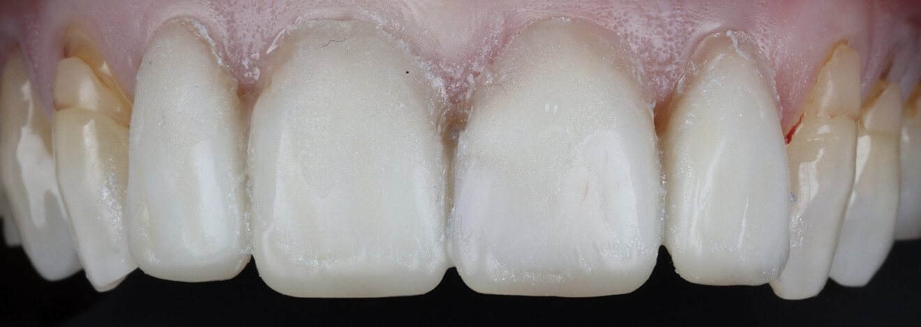 Fig. 3: Additive mock-up fabricated using a flowable composite to evaluate the proposed aesthetic outcome.