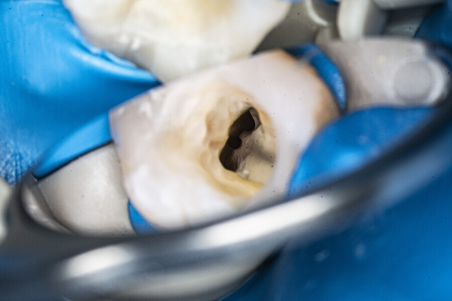 Fig. 31: The distal canals after instrumentation.