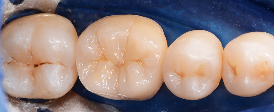 Fig. 11: Seated crown after excess removal.