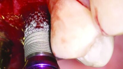 Η ΕΤΑΙΡΕΙΑ ΖΙΜΜΕR ΑΠΟΚΑΛΥΠΤΕΙ ΤΟ ΕΜΦΥΤΕΥΜΑ ΝEXTGEN ΜΕ ΛΕΙΤΟΥΡΓΙΚΙΚΗ ΟΣΤΕΟΕΝΣΩΜΑΤΩΣΗ