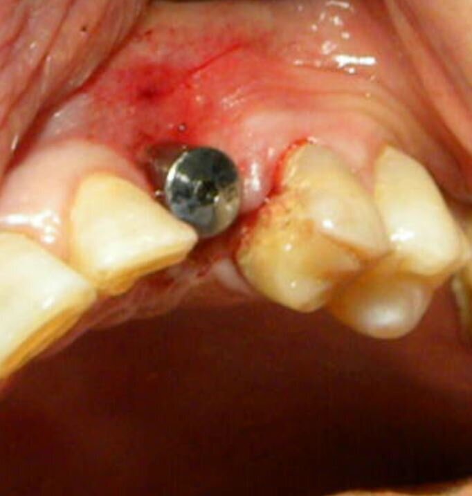 Fig. 11 - Caso clinico 3. Posizionamento della vite di guarigione.