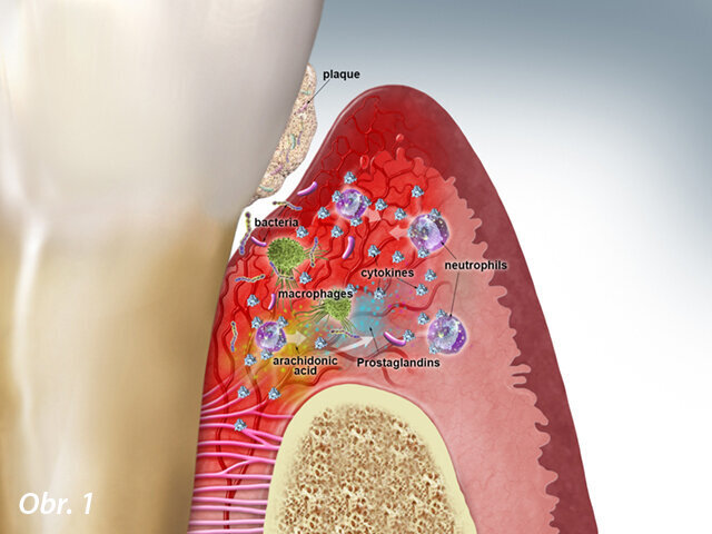 Obr. 1: Akutní odpověď – parodontální tkáň: Bakterie iniciují imunitní odpověď vyvoláním vaskulární dilatace zvýšenou permeabilitou kapilár a zvýšeným průtokem krve. Buněčná úroveň: Sulkulární tekutina obsahuje neutrofily, makrofágy a další zánětlivé buňky. Makrofágy eliminují bakterie fagocytózou. Zánětlivé buňky produkují cytokiny, které regulují zánětlivou odpověď. Biochemická úroveň: Kyselina arachidonová (uvolňovaná primárně neutrofily) produkuje prostaglandin.