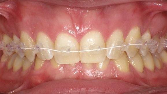 Nuovi traguardi ortodontici al servizio dell’estetica