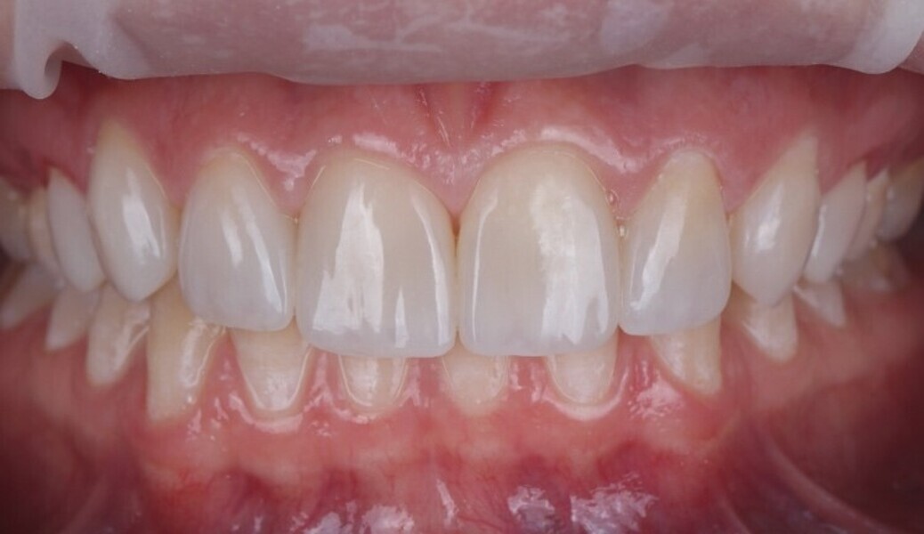 Fig. 3n: Intra oral view of the patient smile after smile modification with direct veneer restorations.