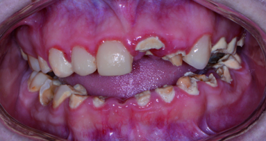 Replacing a failing dentition with new technology