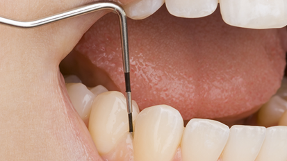 Zahnreport 2017: Parodontitistherapie erfolgt oft zu spät Zahnreport 2017: Parodontitistherapie erfolgt oft zu spät