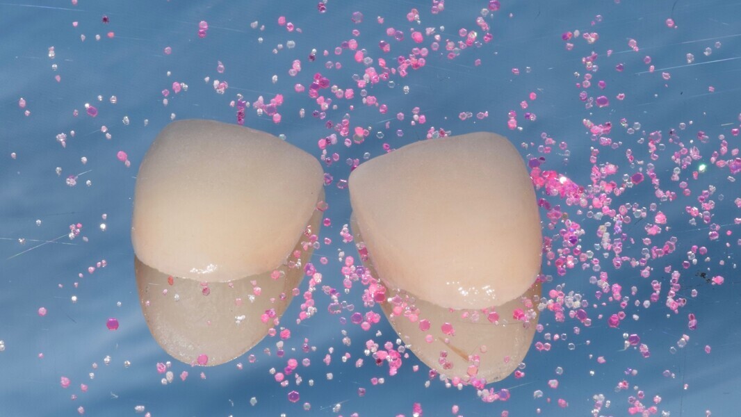 Fig. 2: Ceramic partial fixed dental prostheses (veneers) before the try-in.