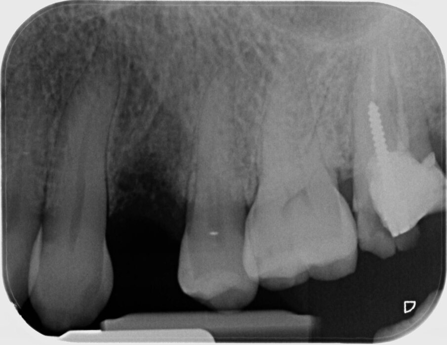 Fig. 7 - Radiografia postoperatoria che mostra il biomateriale in situ.