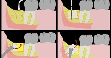 Piezocirugía  (6). Exodoncia de terceros molares simplificada