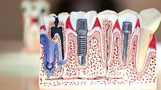 Haben Sozialhilfeempfänger  Darlehensanspruch beim Zahnersatz?