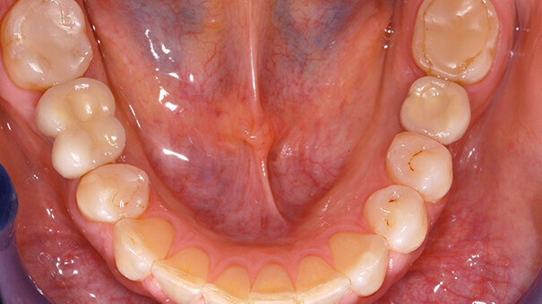 Long-Term Clinical Success with the Neoss Implant System: A Case Report