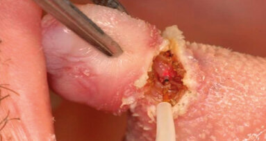 Dolore e qualità di vita in seguito a 118 interventi di chirurgia orale sui tessuti molli: i vantaggi del laser Nd:YAG