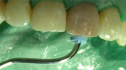 Single-visit apexification withMTA following ozone disinfection