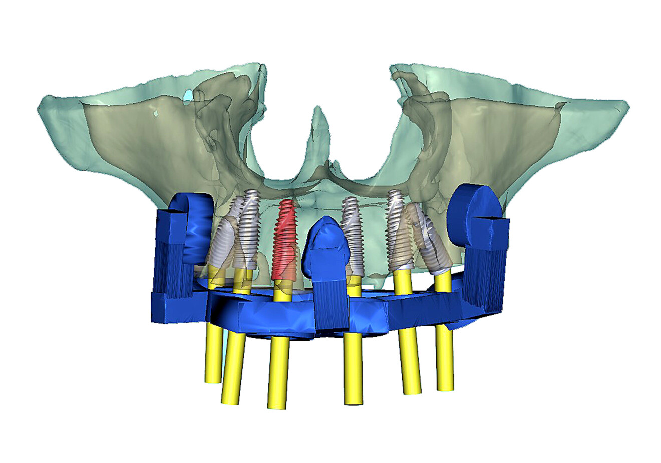 Fig. 7a: Simulation of the novel rotational path nasopalatine canal pin guide (blue) seated on the maxillary bone. Frontal view with selective transparency to visualise implant locations.