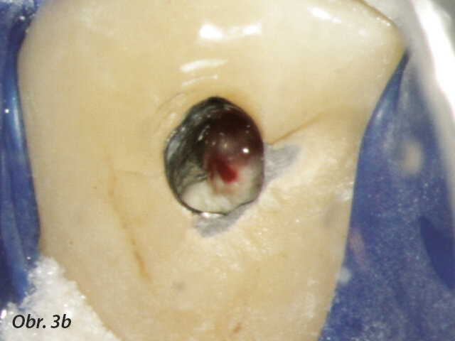 Krvácení z perforace