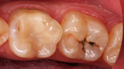 La gestion des caries profondes en technique Bio-Bulk Fill