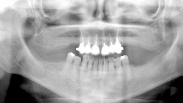 El tratamiento con ozono de la osteonecrosis asociada a bifosfonatos