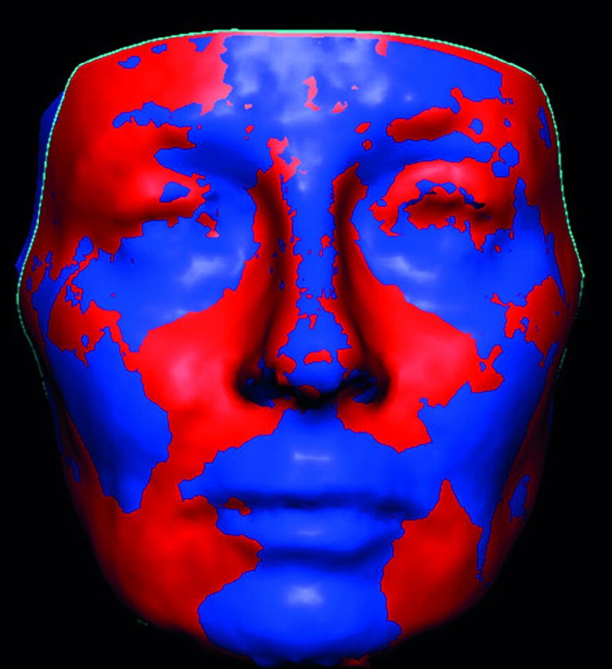 Fig. 6 : Changement morphologique facial dans les lèvres, l’os zygomatique et la région des bajoues, après l’injection de 1 ml de Restylane et de 1,3 cc de Radiesse. Notez la couleur d’un rouge orangé plus profond dans les régions où les injections ont été réalisées.