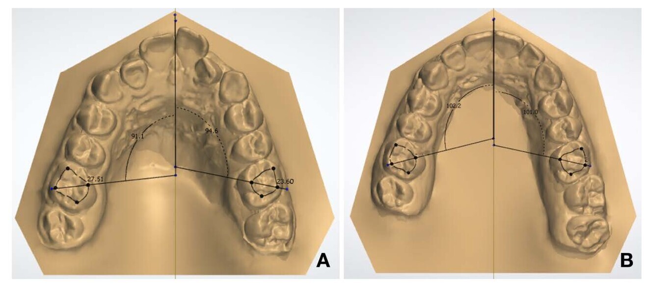 Figs. 23a & b: (a) Pretreatment first molar angulation. (b) Post-treatment first molar angulation (images generated using 3Shape Dental System).