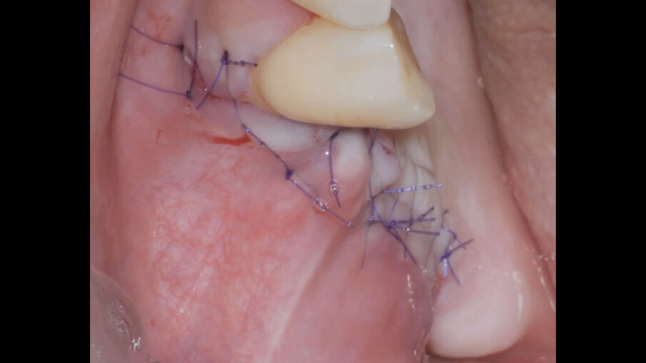 Fig. 13 - Chiusura per prima intenzione e sommersione impianti.