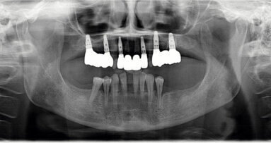 Augmentacija dentinskim graftom u gornjoj čeljusti