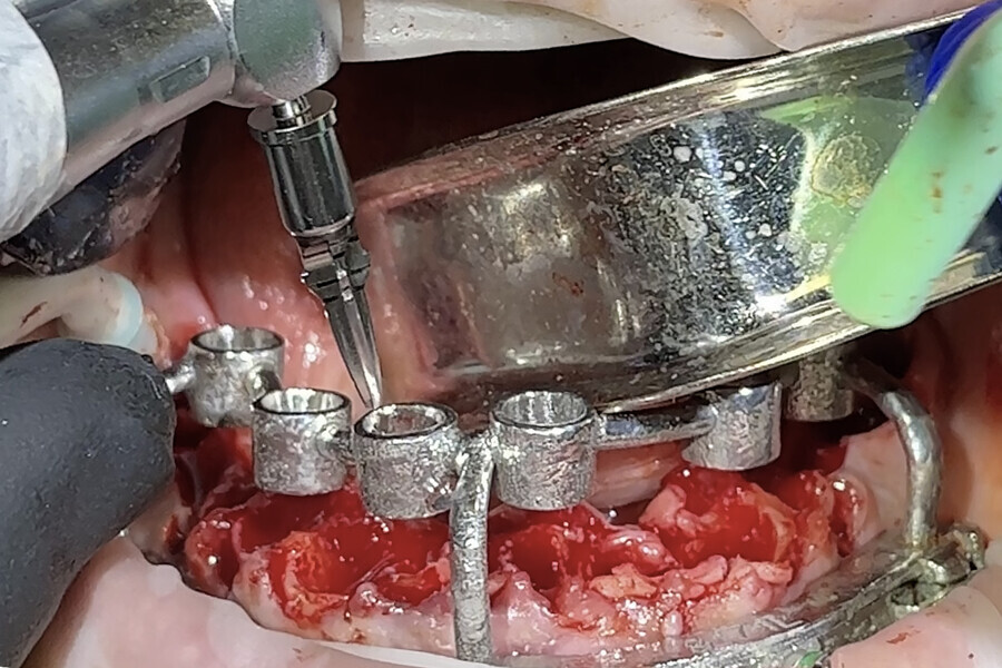 Fig. 13: Guided osteotomy preparation using a Universal Shaper drill with CHROME GuidedSMILE.
