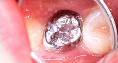 Cochrane finds crowns superior to dental fillings