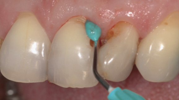 Empirical comparative study confirms thixotropic wound dressing for haemostasis