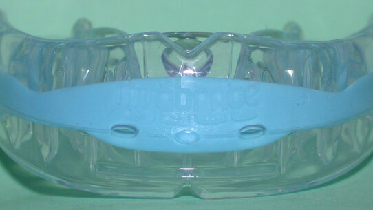 Myobrace: riflessioni, metodi di applicazione e caso clinico