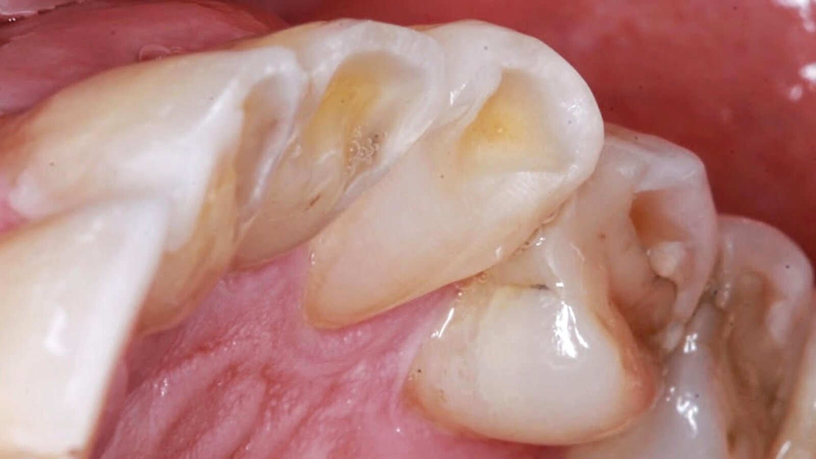 Innovaciones en el manejo del bruxismo y de la ATM (1)