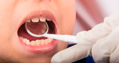 Preventiva zubnog karijesa - komparacija zalivanja i fluoridnih lakova