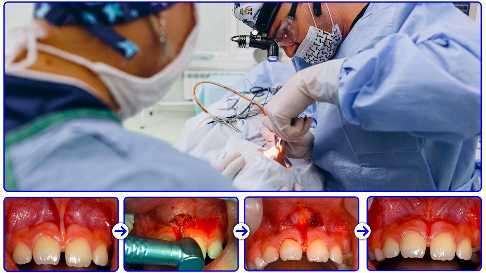 Aplicaciones del láser en Cirugía Bucal (3)