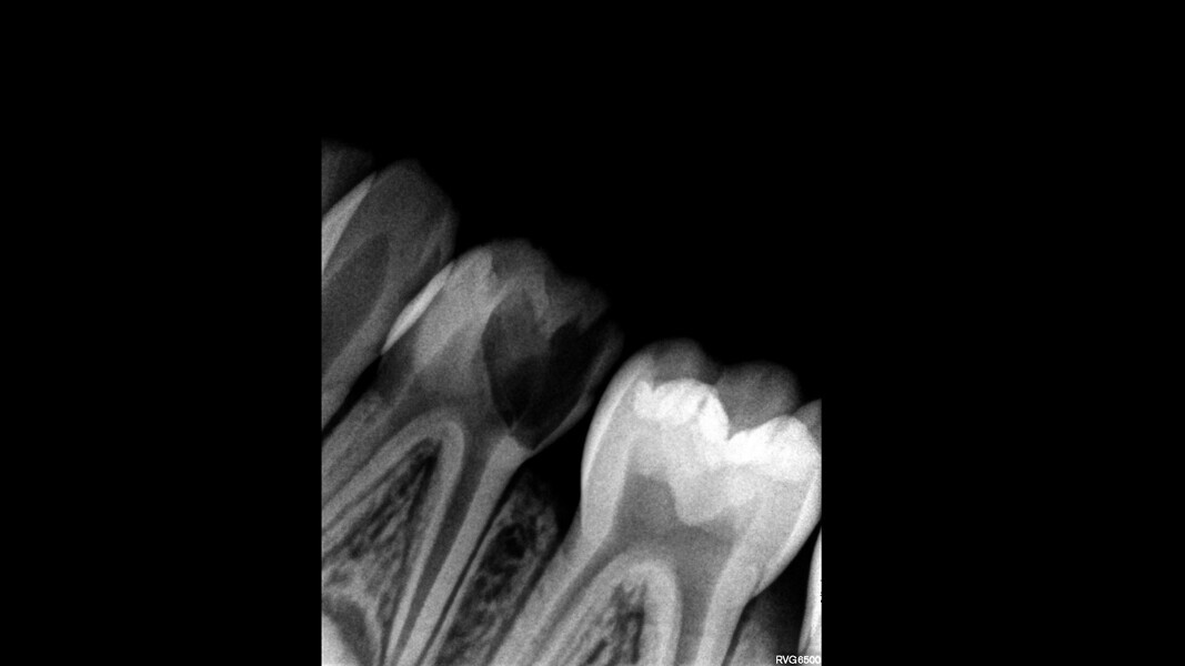 Fig. 10: Initial radiograph.