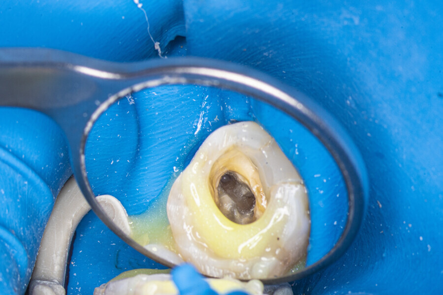 Fig. 15: Temporary build-up for increasing the amount of irrigant during the Less-Prep Endo enhanced irrigation protocol.