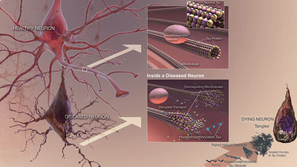 Alzheimer’s, cognitive decline linked to periodontal disease