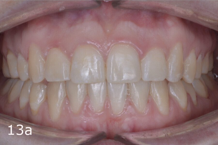 Figs. 13a–f: Final situation. The lack of overjet and overbite and the midlines had been improved and anterior and canine guidance achieved.