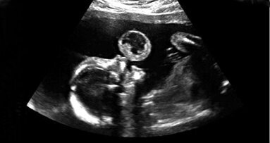 Voor het eerst orale tumor bij foetus verwijderd