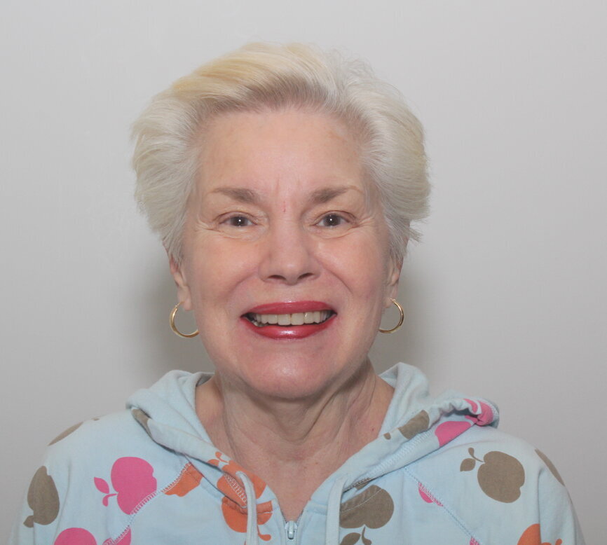 Fig. 24: Postoperative frontal smile.