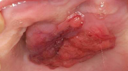 Papillary squamous cell carcinoma of the hard palate: Report of a rare case affecting the oral cavity Papillary squamous cell carcinoma of the hard palate: Report of a rare case affecting the oral cavity