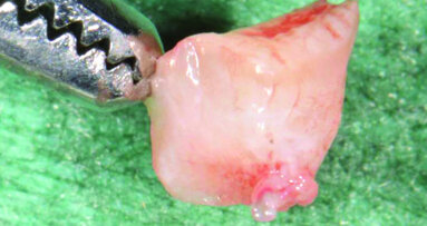 Impianti post-estrattivi precoci abbinati a CTG in sella edentula intercalata