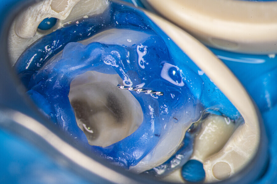 Fig. 19: Second removed piece of the broken file.