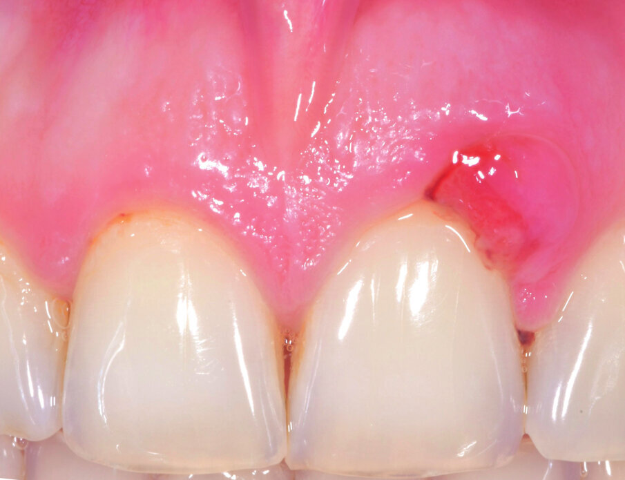 Fig. 1 - Aspetto clinico del paziente alla prima visita. Viene applicato Ozosan® per 8 min e lavato con fisiologica.