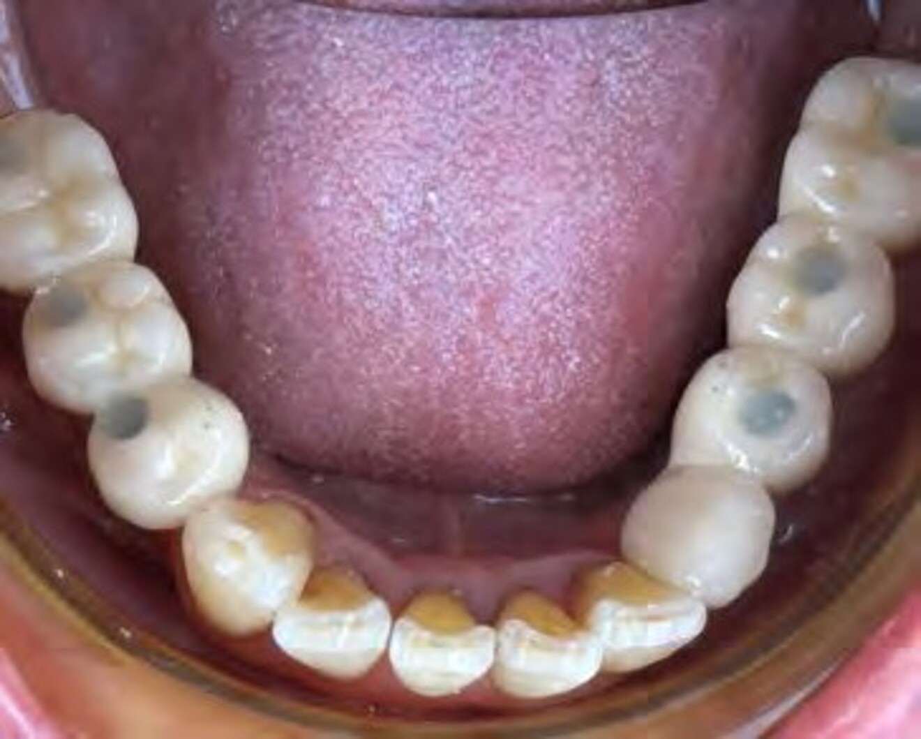 Fig. 3h: Mandibular occlusal view demonstrating the completed implant-sup ported prosthetic rehabilitation and occlusal relationship.