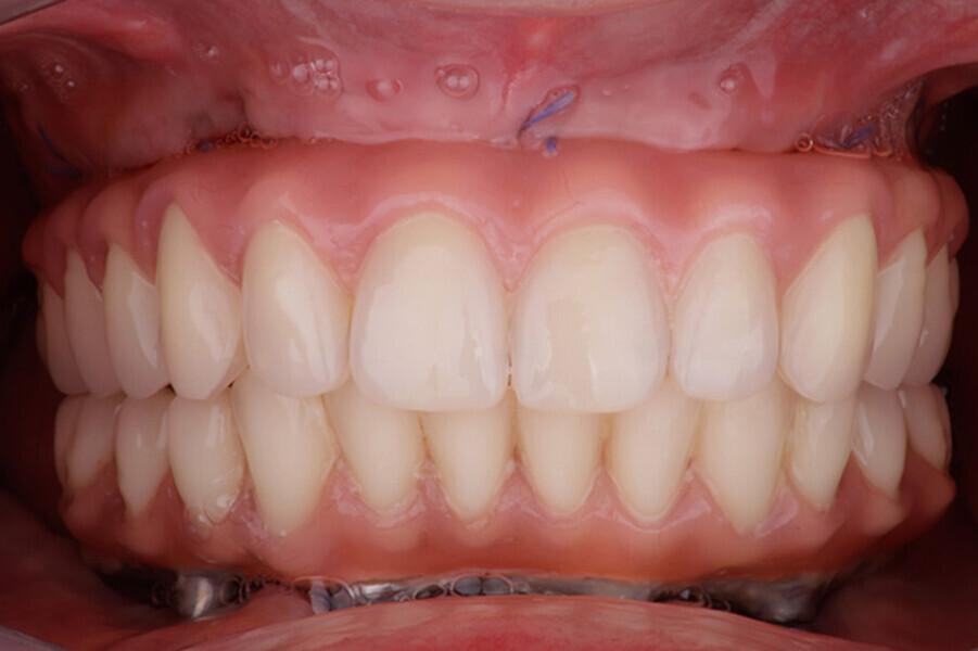 Fig. 15. Rx Control y Prótesis híbrida inmediata con 5 años de evolución.