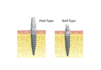 ProTem Implant System