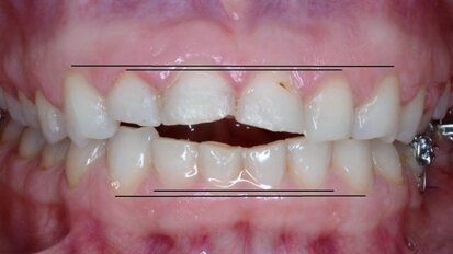 Maloccluzia asociată cu controlul deficitar al posturii și echilibrului