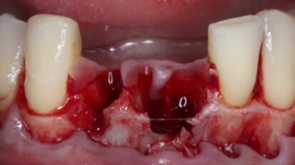 Vitamina D y Oseointegración