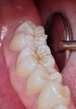 Fig. 6: After removal of the stamp, the nicely shaped occlusal anatomy could immediately be seen.