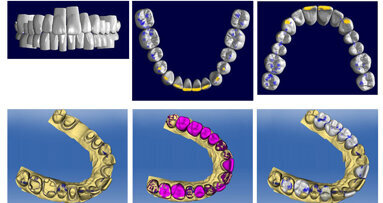 CEREC Biojaw - typical tooth restorations for the whole jaw