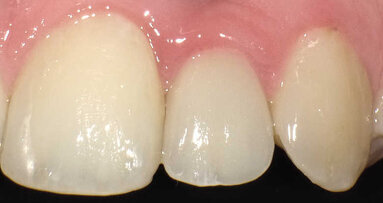 Ouverture de l’espace inter-radiculaire pour la pose d’un implant étroit